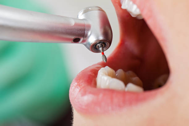 Best Emergency Tooth Extraction in La Verne, CA